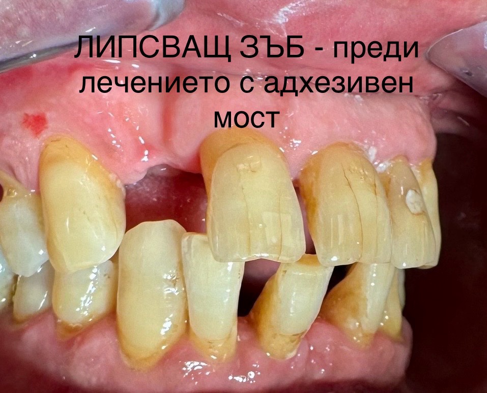 поставяне на адхезивен мост